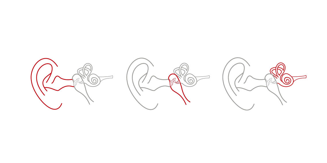 Éxito en la adaptación de Audífonos en Modalent