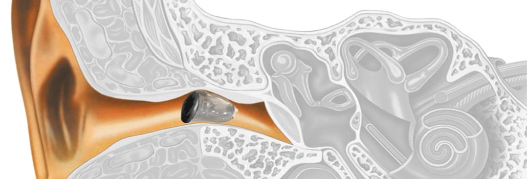Adaptación personalizada de audífonos en Puerto Mazarrón con Modalent